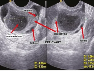 Side-by-side transvaginal ultrasound images of the left ovary with arrows and labels marking an endometrioma, ovarian parenchyma, and multiple follicles; screen shows measurements (approx. 4.06 × 2.25 × 3.51 cm; volume ~16.8 mL).